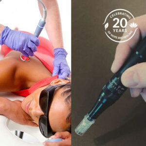 RF Microneedling + EmVital Package